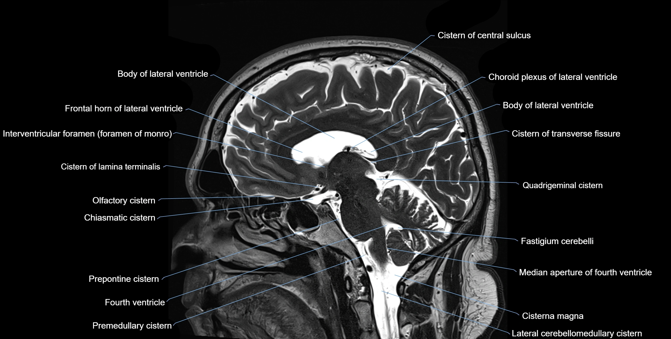 Brain cisterns  and ventricles sagittal anatomy 3T MRI image-img-00001-00032.webp
